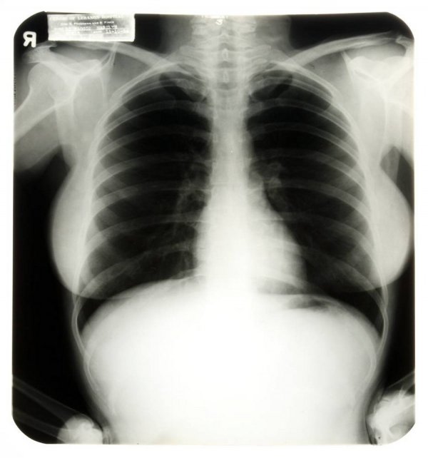 
Рентгеновский снимок Мэрилин Монро от 10 ноября 1954 года
